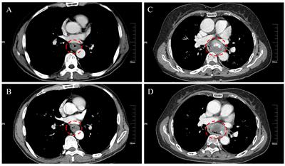 Clinicopathologic features and surgical treatment prognosis of esophageal carcinosarcoma